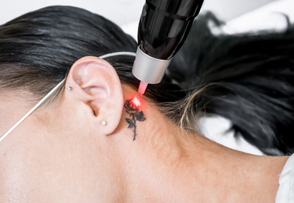 Three Laser Tattoo Removal Sessions for an Area up to 30cm2 - Options for One or Five Sessions