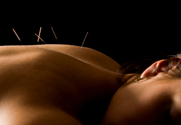 Wellbeing 60-Minute Acupuncture Session - Valid Monday to Friday