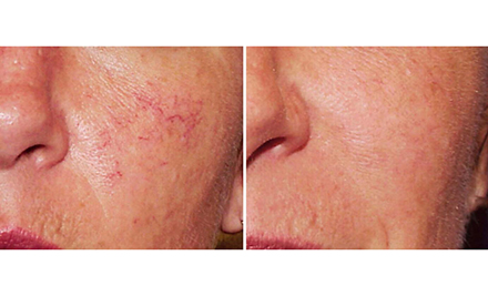 From $69 for IPL Pigmentation, Freckle, Acne, or Rosacea/Vein Treatment (value up to $560)