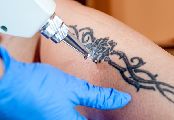 Two Professional Laser Tattoo Removal Treatments