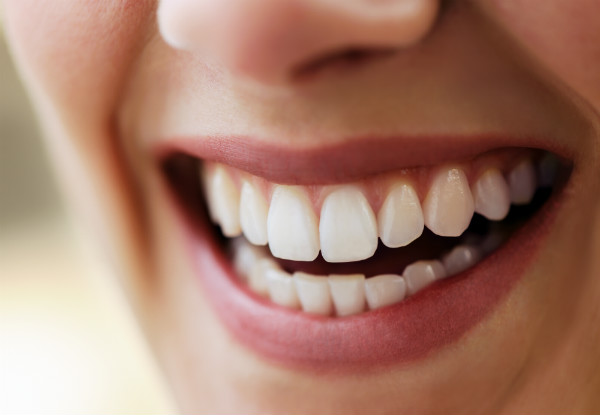 Certified Teeth Whitening Package for Freshen-Up Treatment incl. $50 Return Voucher - Options for Medium to Heavy Staining Treatments - New Plymouth
