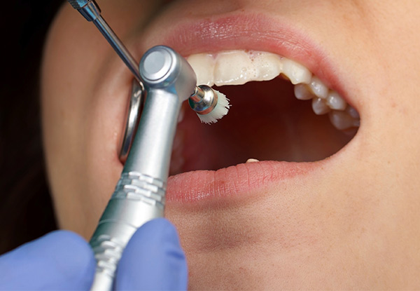 Clean, Scale & Polish with Option to incl. a Full Mouth Examination & X-Rays