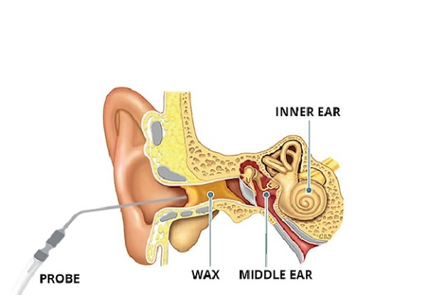 Micro-Suction Ear Wax Removal