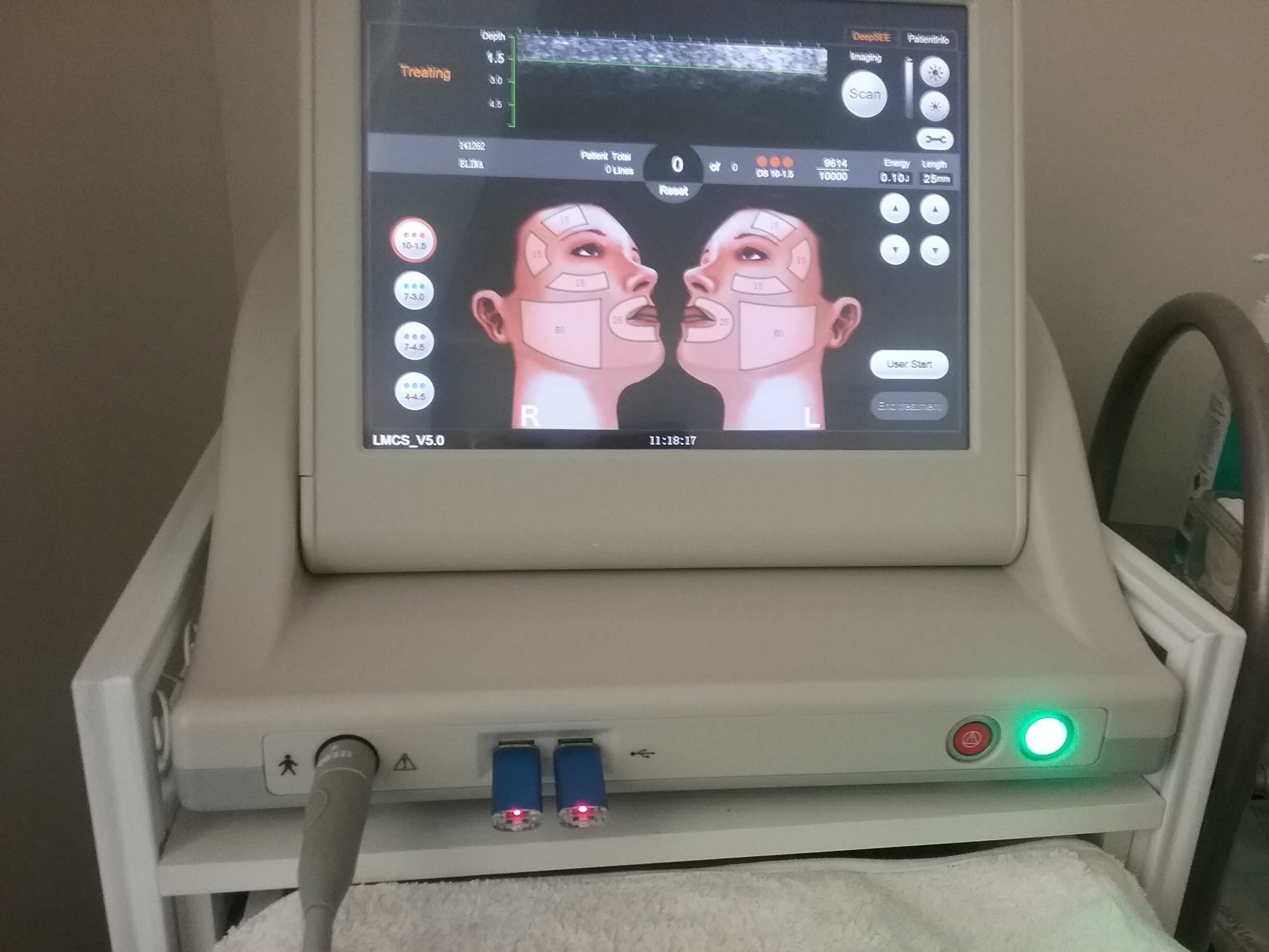 90-Minute HIFU (High Intensity Focused Ultrasound)