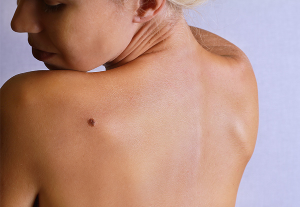 Full Mole Check & Consultation for One Person at St Lukes Medical Centre